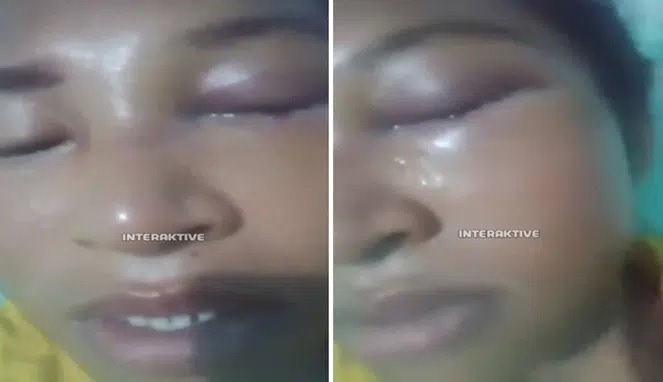 Tangan Suami Biadab Wajah Istri Hancur Akibat Kekerasan Sadis